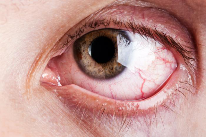 眼部瘙痒的原因、治疗和预防